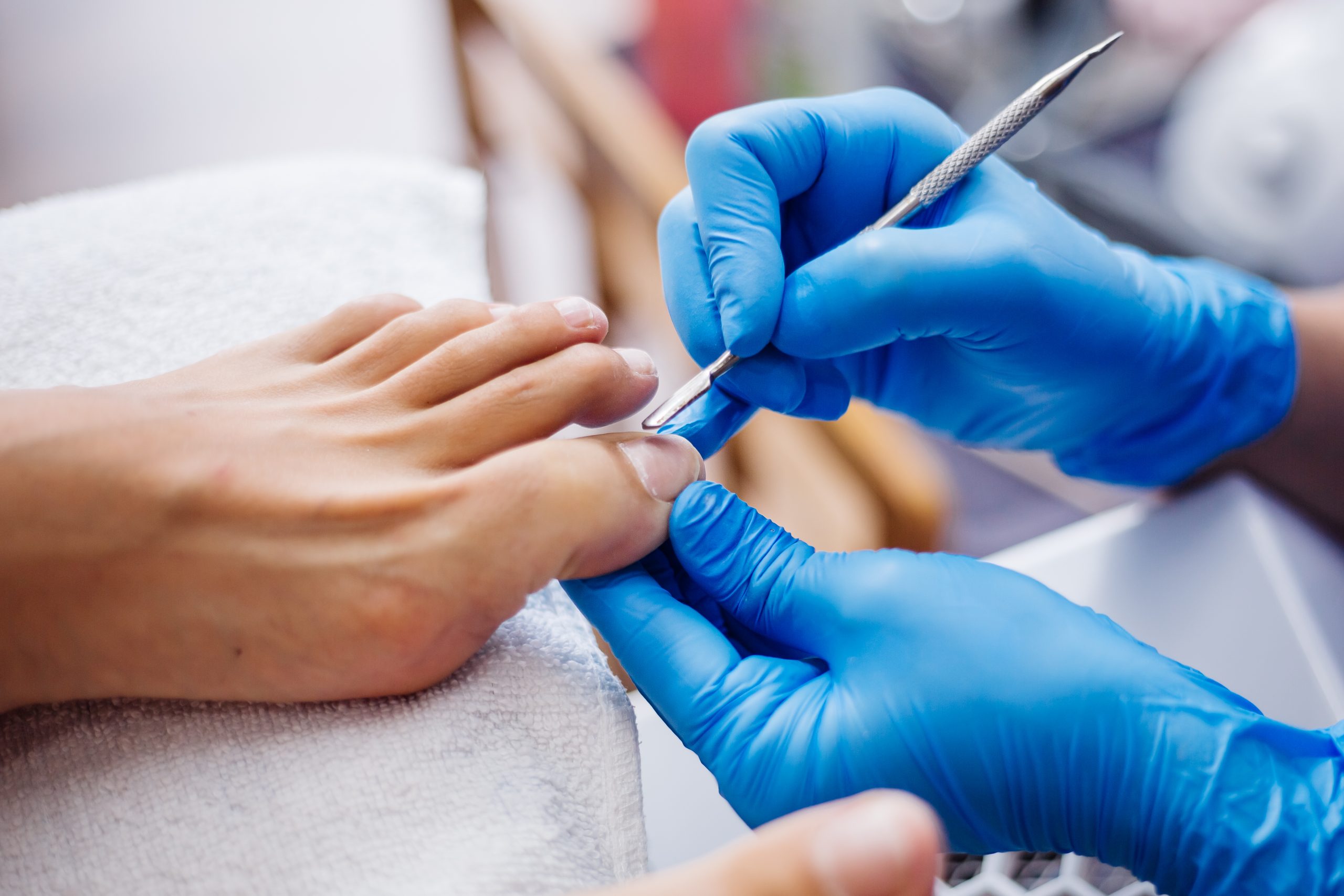 Ingrown Toenail Treatment